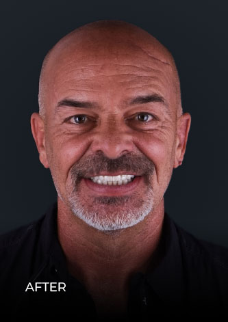 front shot of CDS patient, after getting All on 4 implants in Cancun