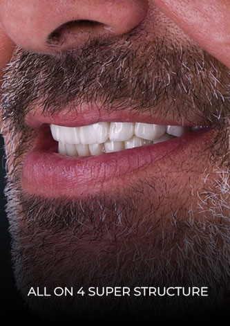 close-up shot of CDS patient, after getting All On 4 implants in Cancun