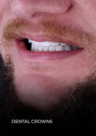 smile close up after his full mouth reconstruction with crowns and implants in Mexico