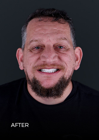 CDS Cancun patient after getting dental crowns in Mexico