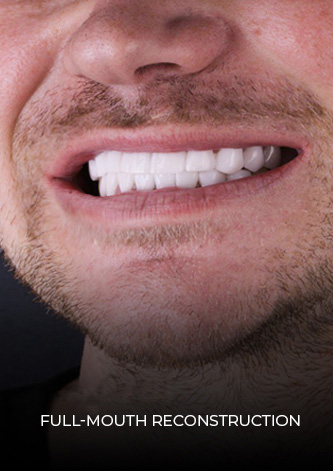 smile close up after his full mouth reconstruction with crowns and implants in Mexico