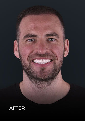 cds patient smiling after getting Emax porcelain veneers in Mexico