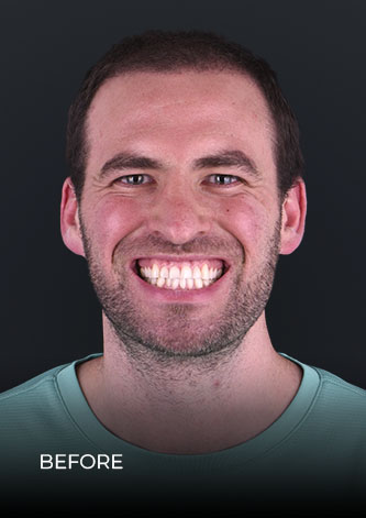 cds patient smiling before getting Emax porcelain veneers in Mexico