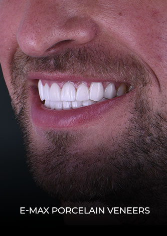 patient at dental work mexico final restoration with emax veneers