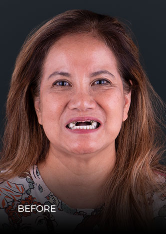 dental work mexico patient smiling before getting her dental bridges