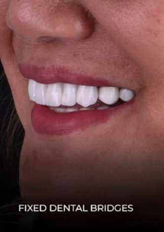 dental work mexico patient  final restoration with fixed dental bridges