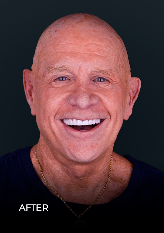 dental work mexico patient smiling after getting his full mouth crowns 