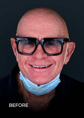 dental work mexico patient  smiling before getting his full mouth crowns