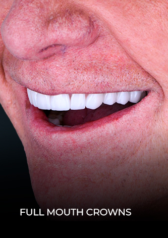 dental work mexico patient final mouth reconstruction with dental crowns