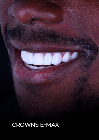 dental work mexico patient final restoration with same day crowns