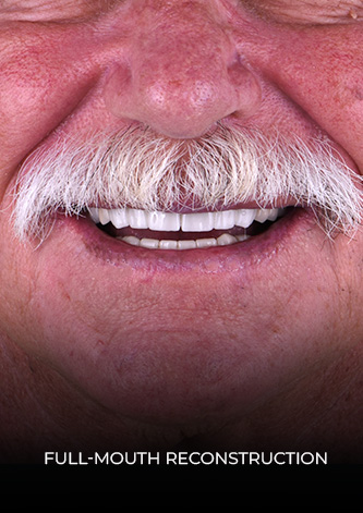 Close up shot at smile after his full mouth reconstruction in Mexico