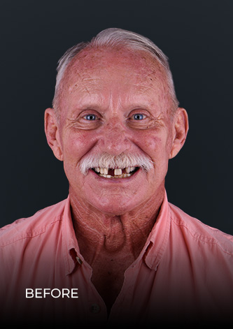Patient after his full mouth reconstruction at Ocean Dental Cancun