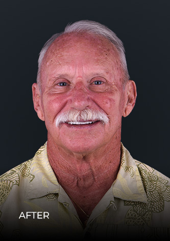 Patient before his full mouth reconstruction at Ocean Dental Cancun