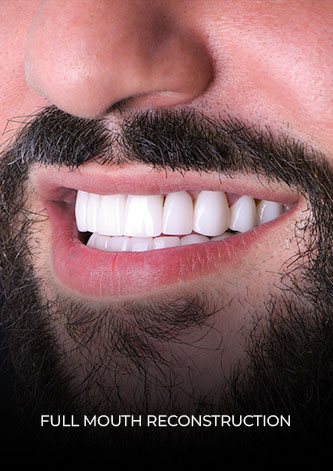 Dental Work Mexico´s patient Full-mouth reconstruction smile close-up