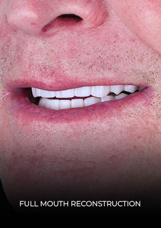 Dental Work Mexico´s patient Full-mouth reconstruction smile close-up