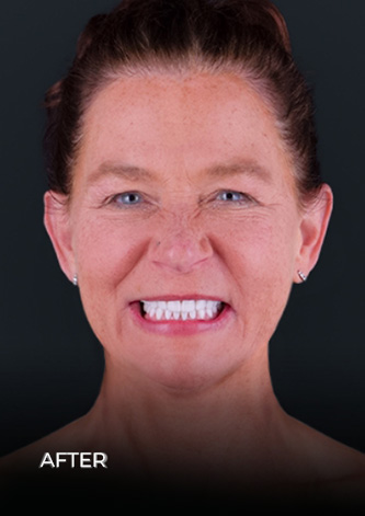 Dental Work Mexico Full smile makeover after shot