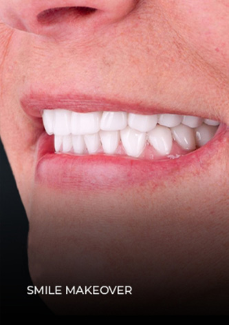 Dental Work Mexico Full-mouth smile makeover close-up shot