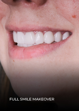 smile close up shot after her full smile makeover treatment