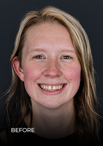 after getting a full smile makeover in Mexico