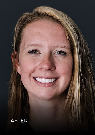 before getting a full smile makeover in Mexico