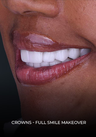 Close up shot at smile after her dental work in Mexico