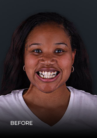 Patient after her full smile makeover at Ocean Dental Cancun