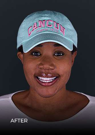 Patient before her full smile makeover at Ocean Dental Cancun