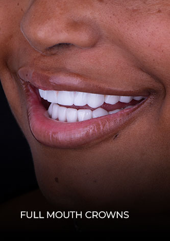 Close-up shot smile after a full mouth reconstruction with crowns