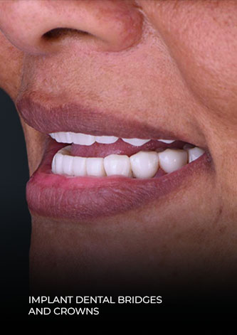 close-up of patient smile after her teeth reconstruction with implant dental bridges