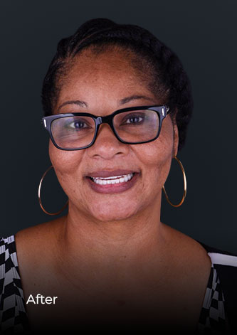 patient smiling after her teeth restoration with implant-fixed dental bridges in Mexico