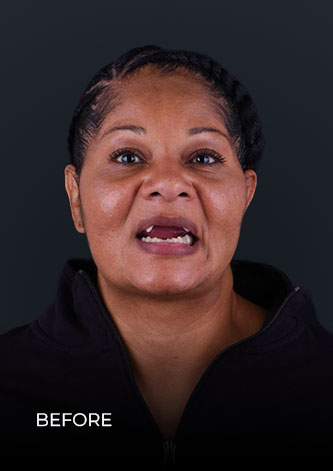 patient smiling before gettinh her teeth restored with implant-fixed dental bridges in Mexico