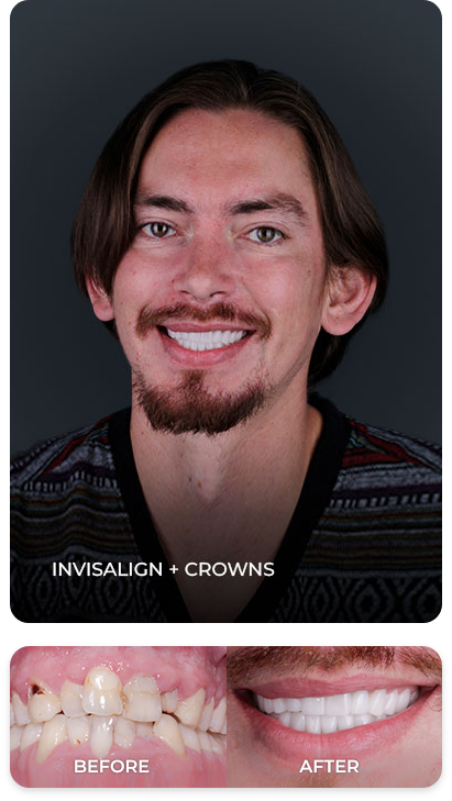 invisalign before and after