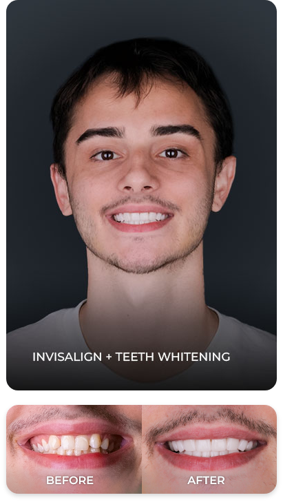 teeth whitening before and after