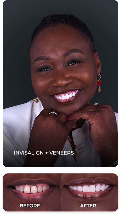 invisalign veneers before and after
