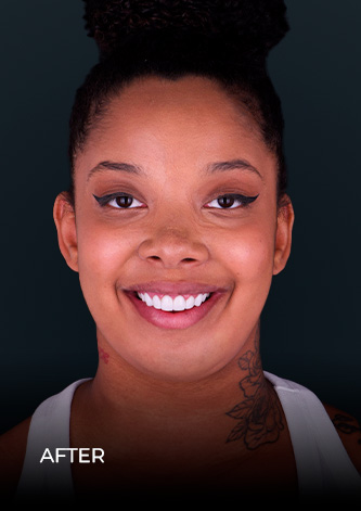 dental work mexico patient  smiling  after getting her crowns