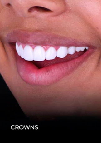 dental work mexico patient final dental restoration with crowns