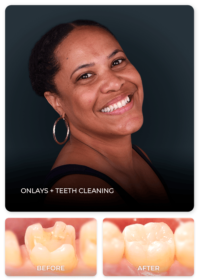 dental onlay before and after
