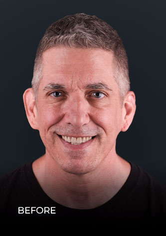 patient at ocean dental cancun smiling before his laser teeth whitening in Mexico