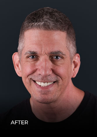 patient at ocean dental cancun smiling after his laser teeth whitening in Mexico