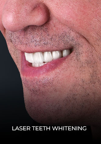 professional-teeth-whitening-before-after-mexico-03 Close up smile after his laser teeth whitening