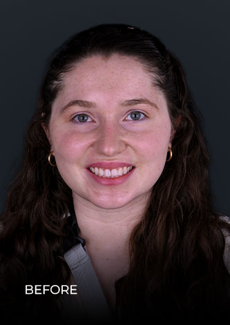 smiling before using teeth whitening trays