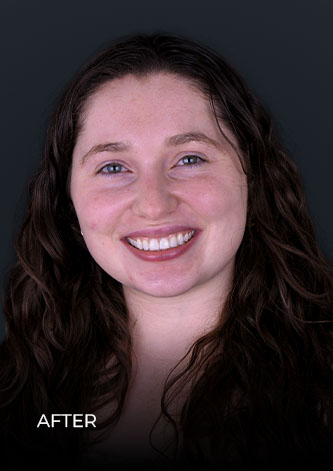 smiling after using teeth whitening trays