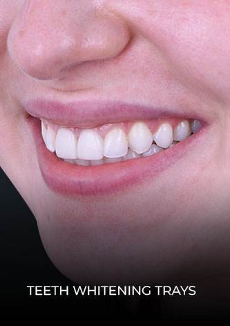 Close up smile after wearing teeth whitening trays