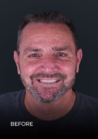 Patient before getting zoom teeth whitening in mexico