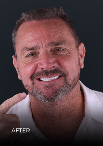 Patient after getting zoom teeth whitening in mexico