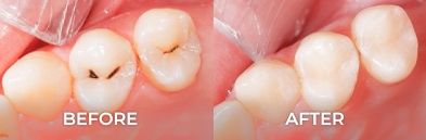molar teeth root canal before and after