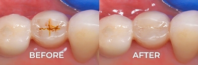 molar teeth root canal before and after