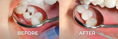 molar teeth root canal before and after