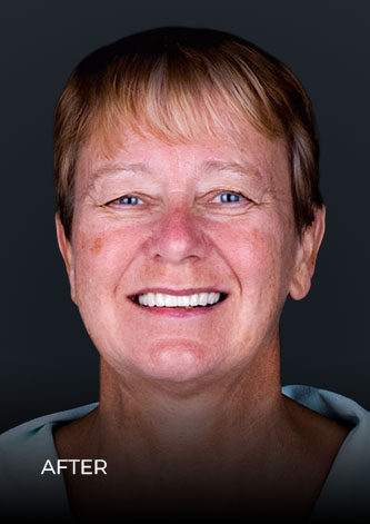 patient of Dental Work Mexico, smiling after her restoration with All On 4 dental implants