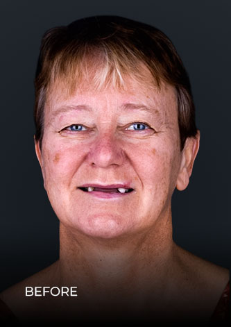 patient of Dental Work Mexico, smiling before her restoration with All On 4 dental implants